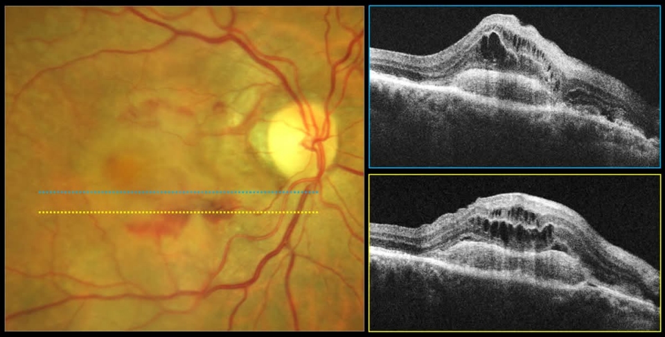 Cirugía de retina