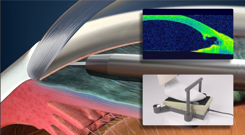 glaucoma