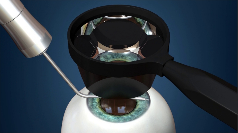 glaucoma
