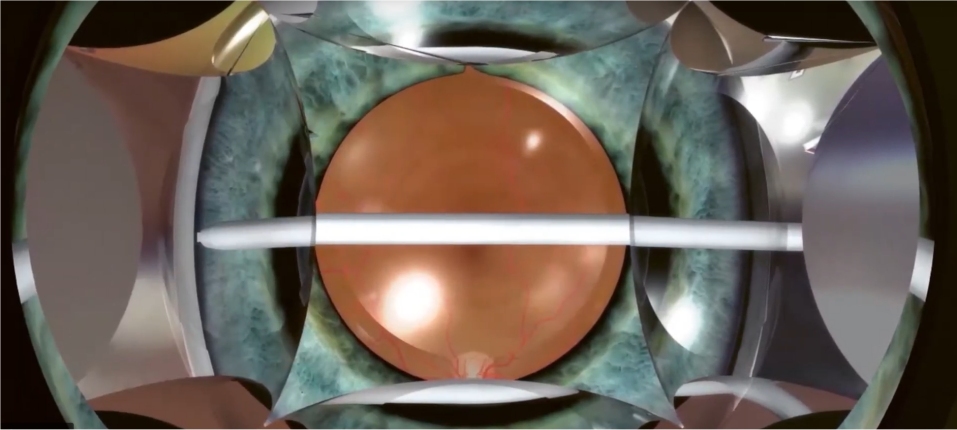glaucoma