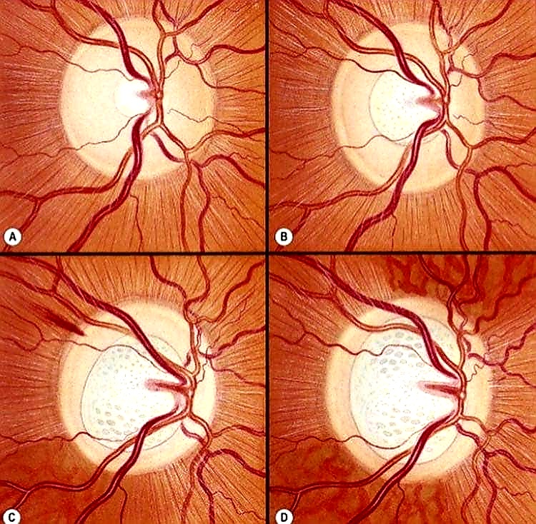 glaucoma