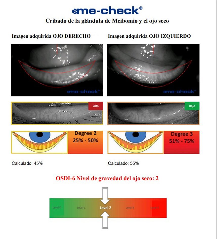 Cirugía de retina