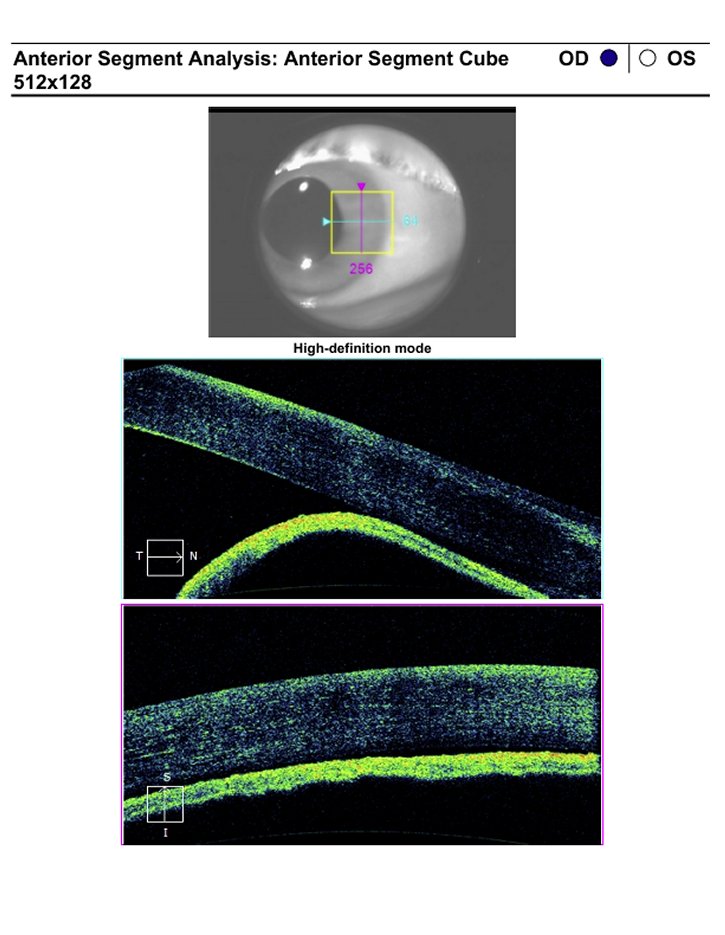 Cirugía de retina